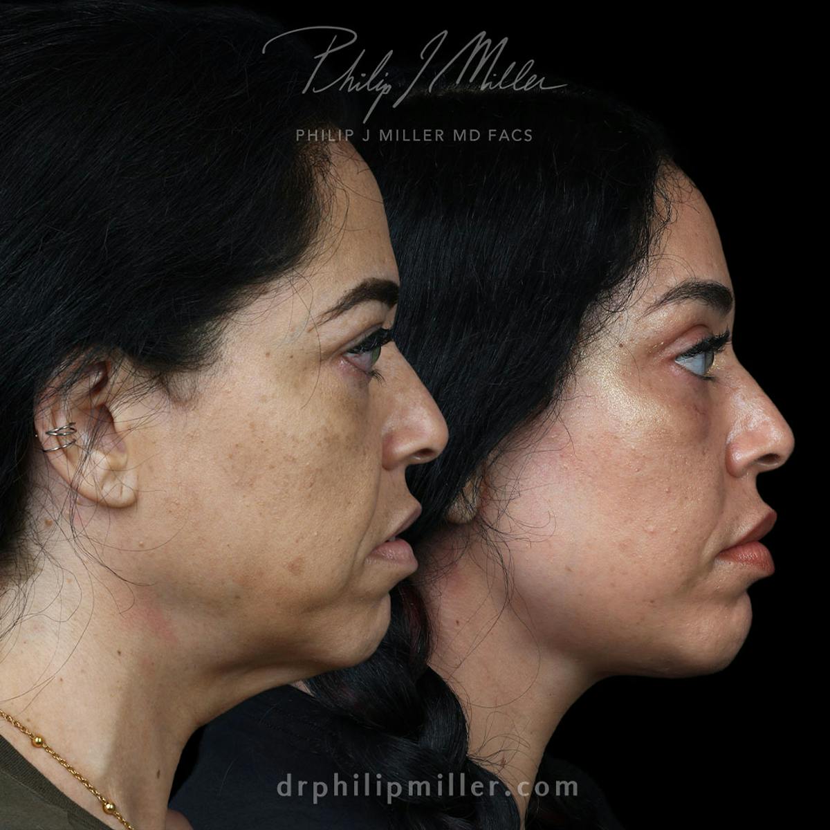 Facelift/NatraLift Before & After Gallery - Patient 227860 - Image 3