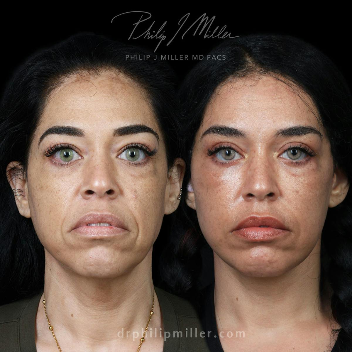 Facelift/NatraLift Before & After Gallery - Patient 227860 - Image 1