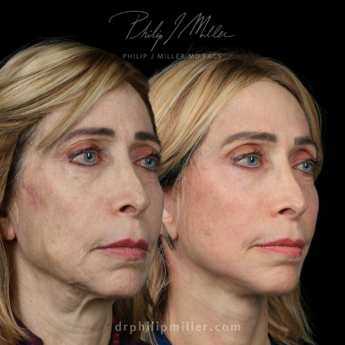 Neck Lift Before & After Gallery - Patient 323983 - Image 1