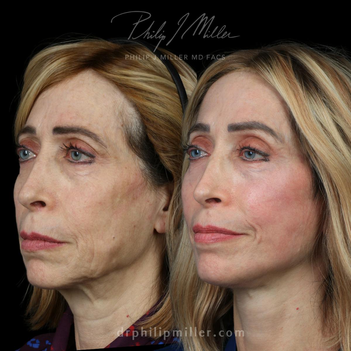 Neck Lift Before & After Gallery - Patient 323983 - Image 2