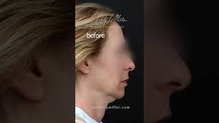 Woman's side profile pre facelift surgery
