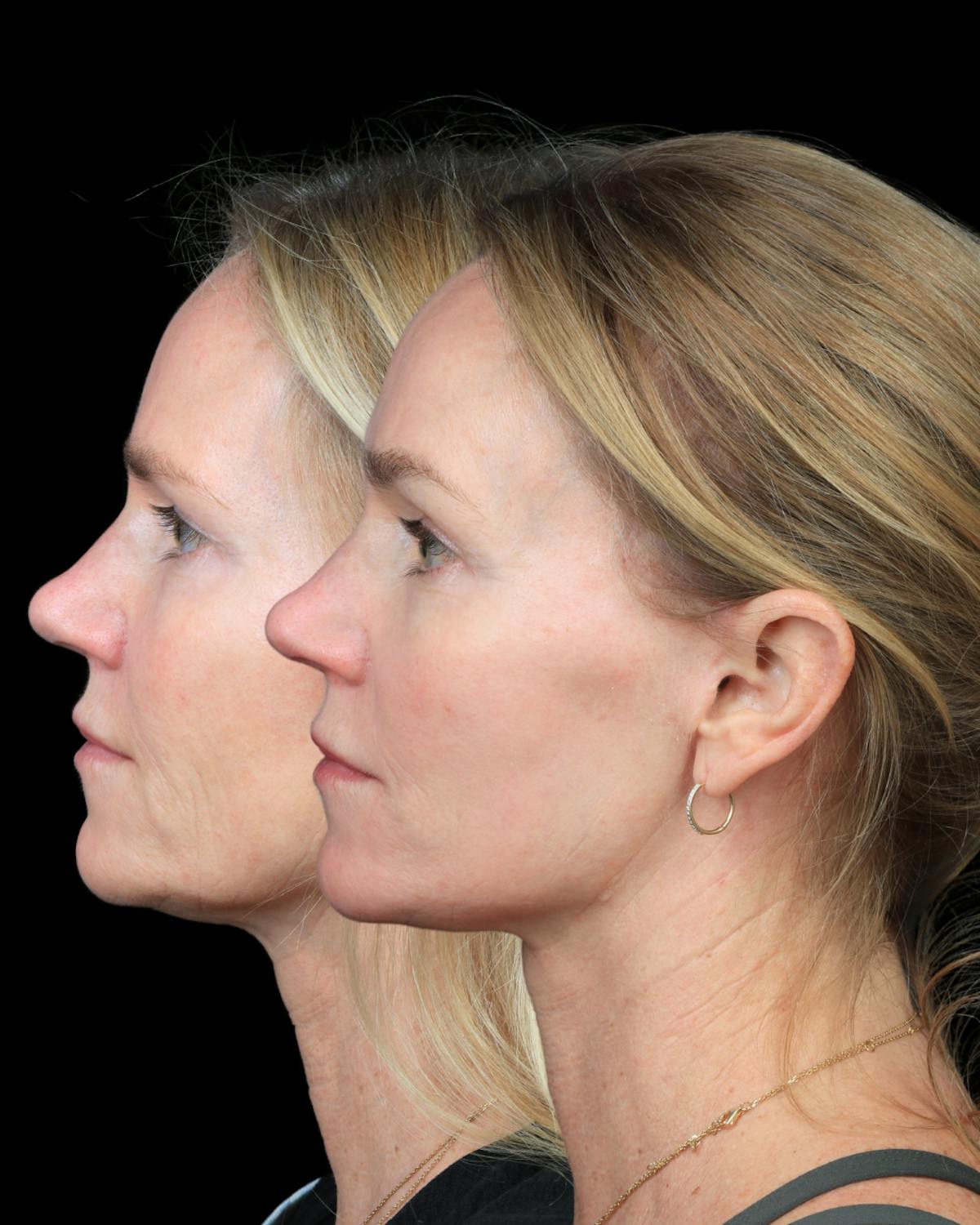 Neck Lift Before & After Gallery - Patient 138394 - Image 5