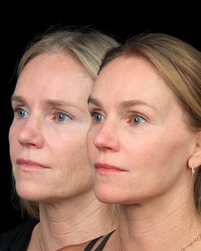 Facelift/NatraLift Before & After Gallery - Patient 321330 - Image 1