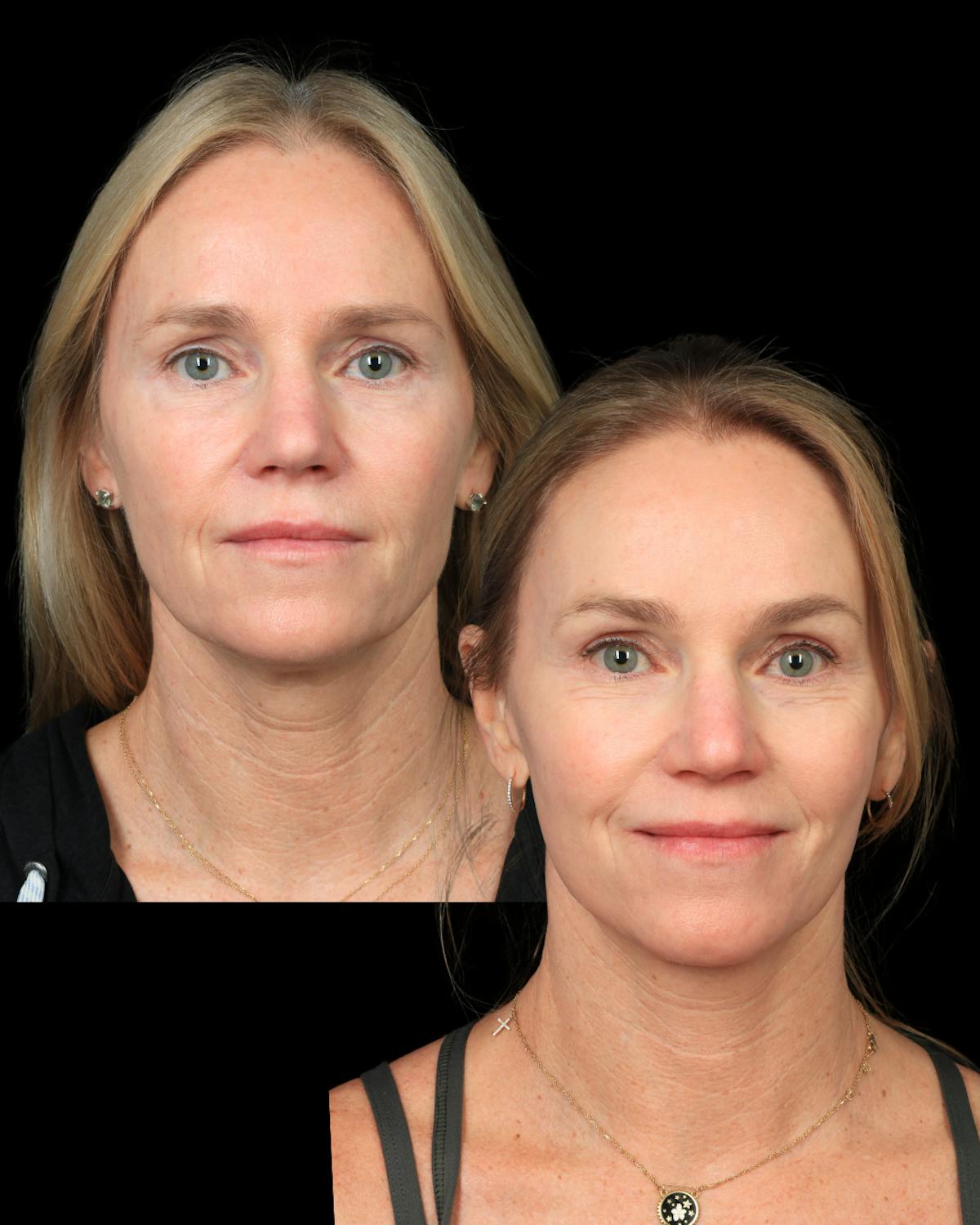Neck Lift Before & After Gallery - Patient 138394 - Image 2