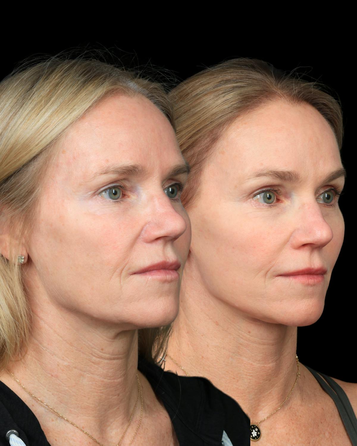Neck Lift Before & After Gallery - Patient 138394 - Image 3