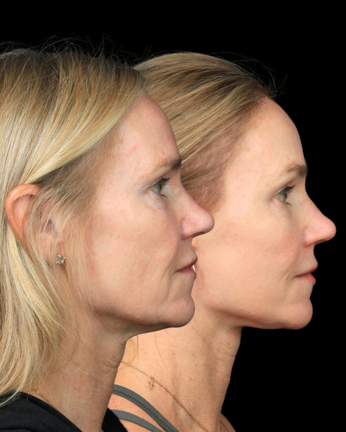 Neck Lift Before & After Gallery - Patient 138394 - Image 4