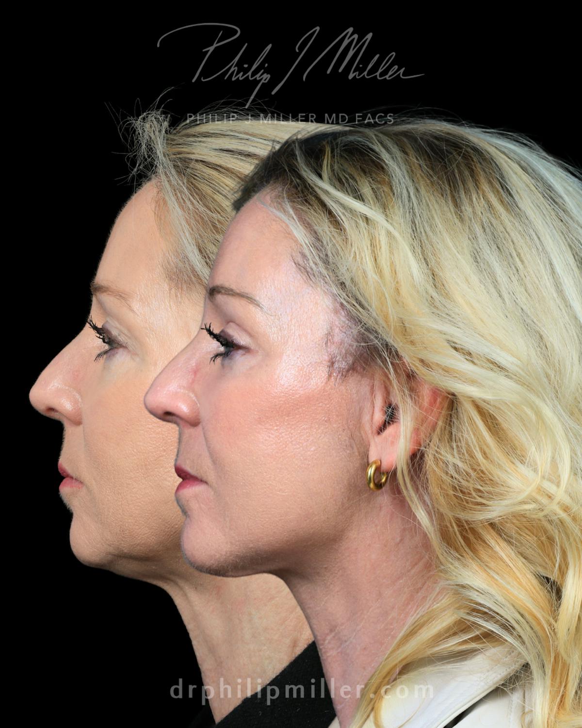 Micro Lift Before & After Gallery - Patient 235706 - Image 5