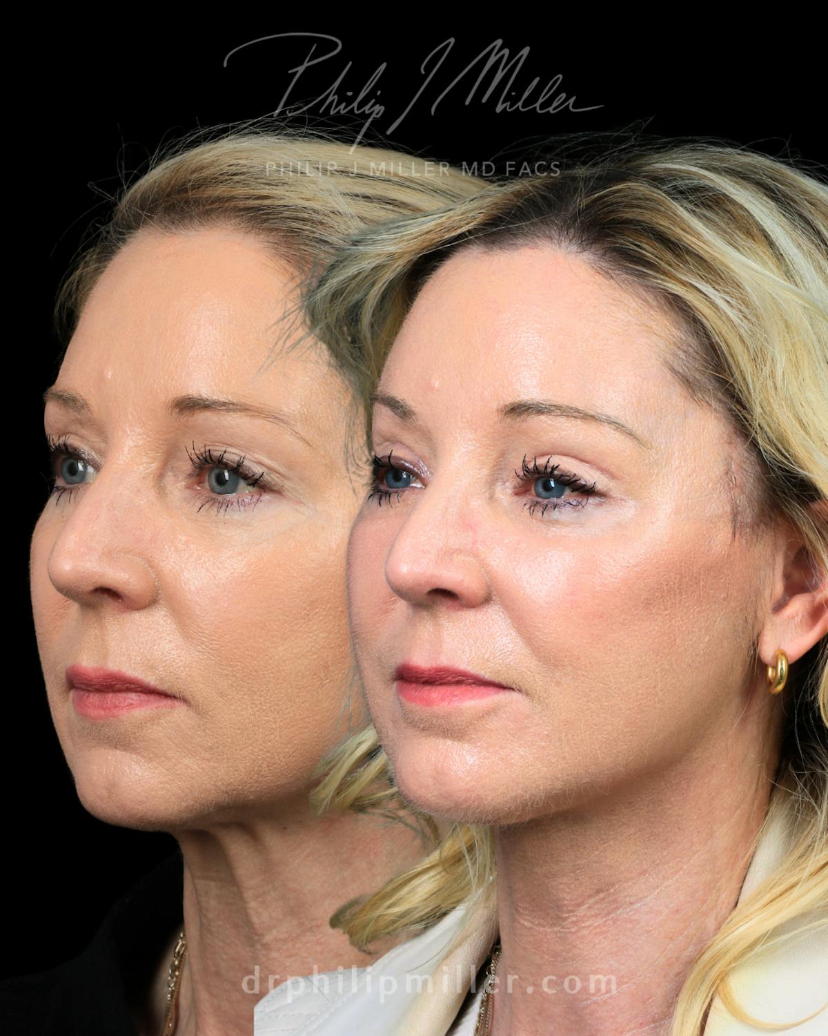 Micro Lift Before & After Gallery - Patient 235706 - Image 1