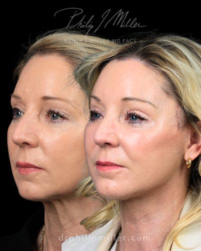 Micro Lift Before & After Gallery - Patient 235706 - Image 1
