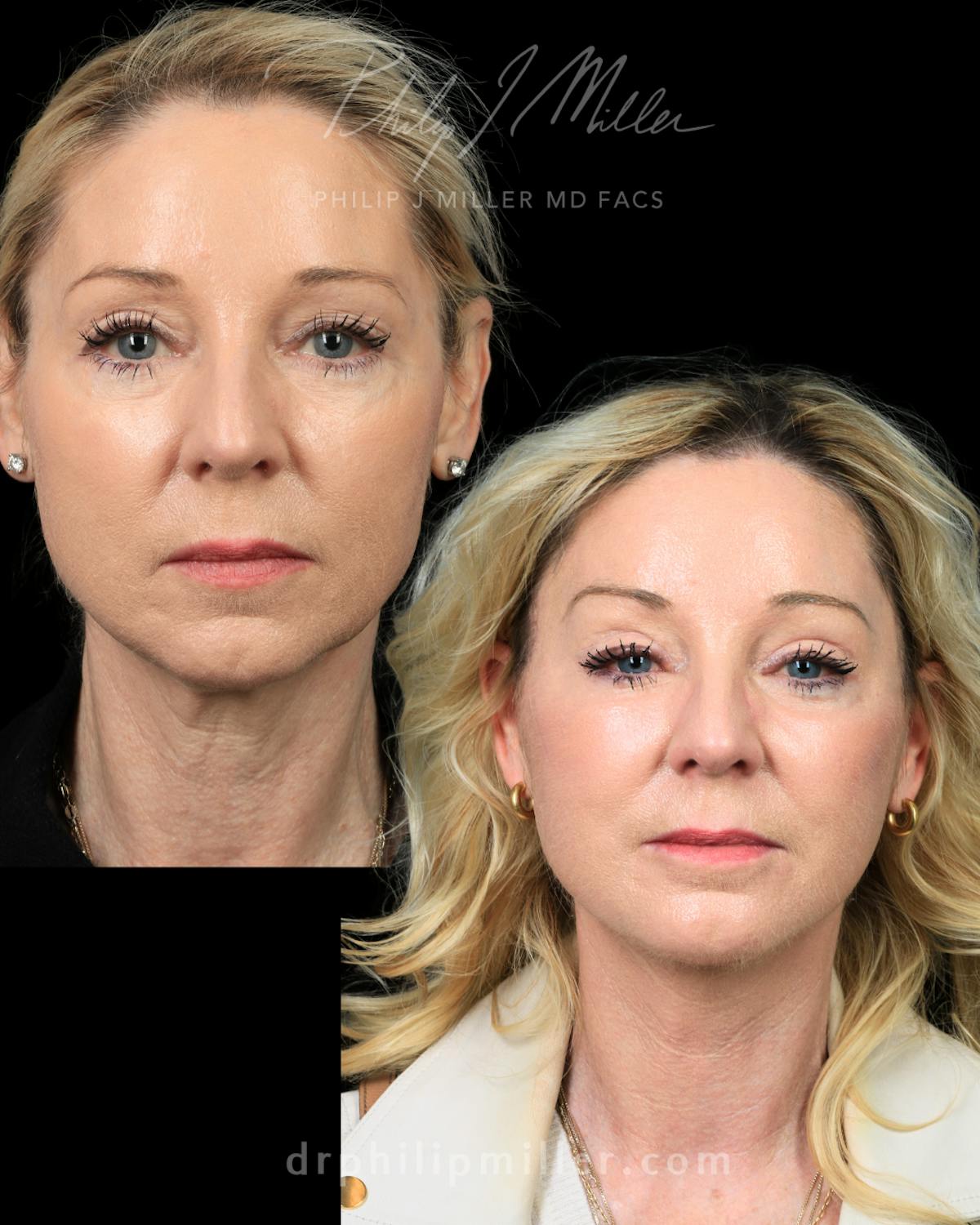 Micro Lift Before & After Gallery - Patient 235706 - Image 4