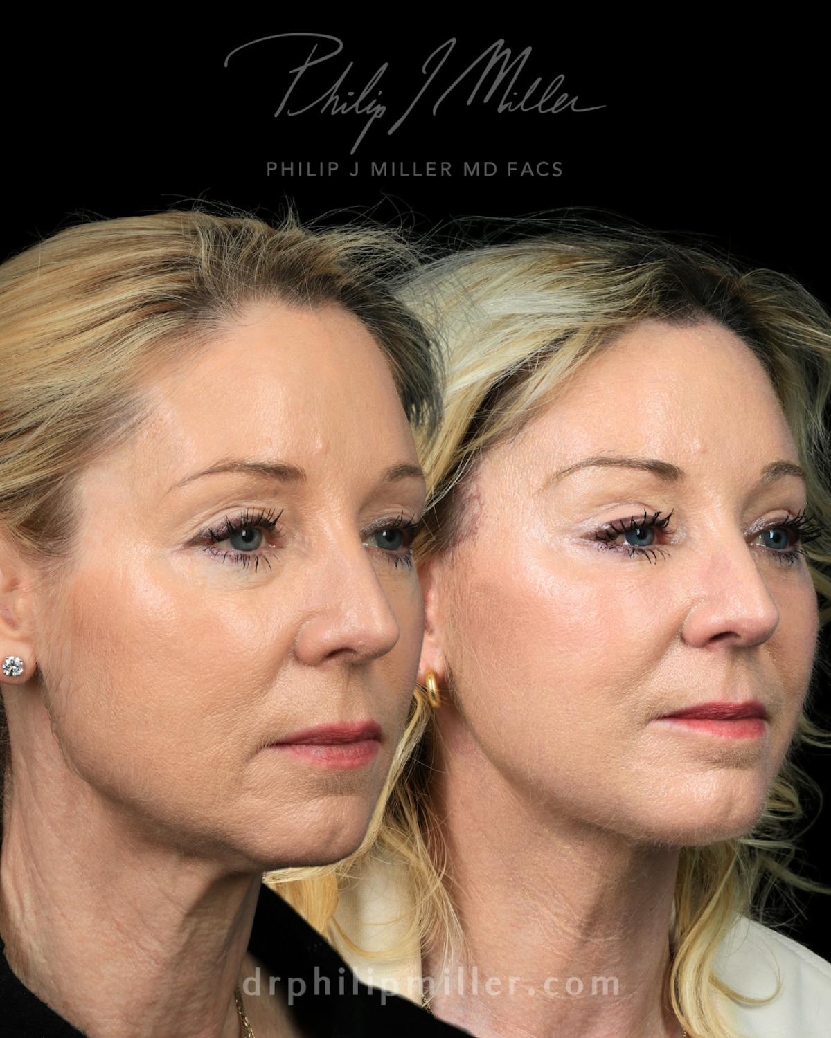 Micro Lift Before & After Gallery - Patient 235706 - Image 2