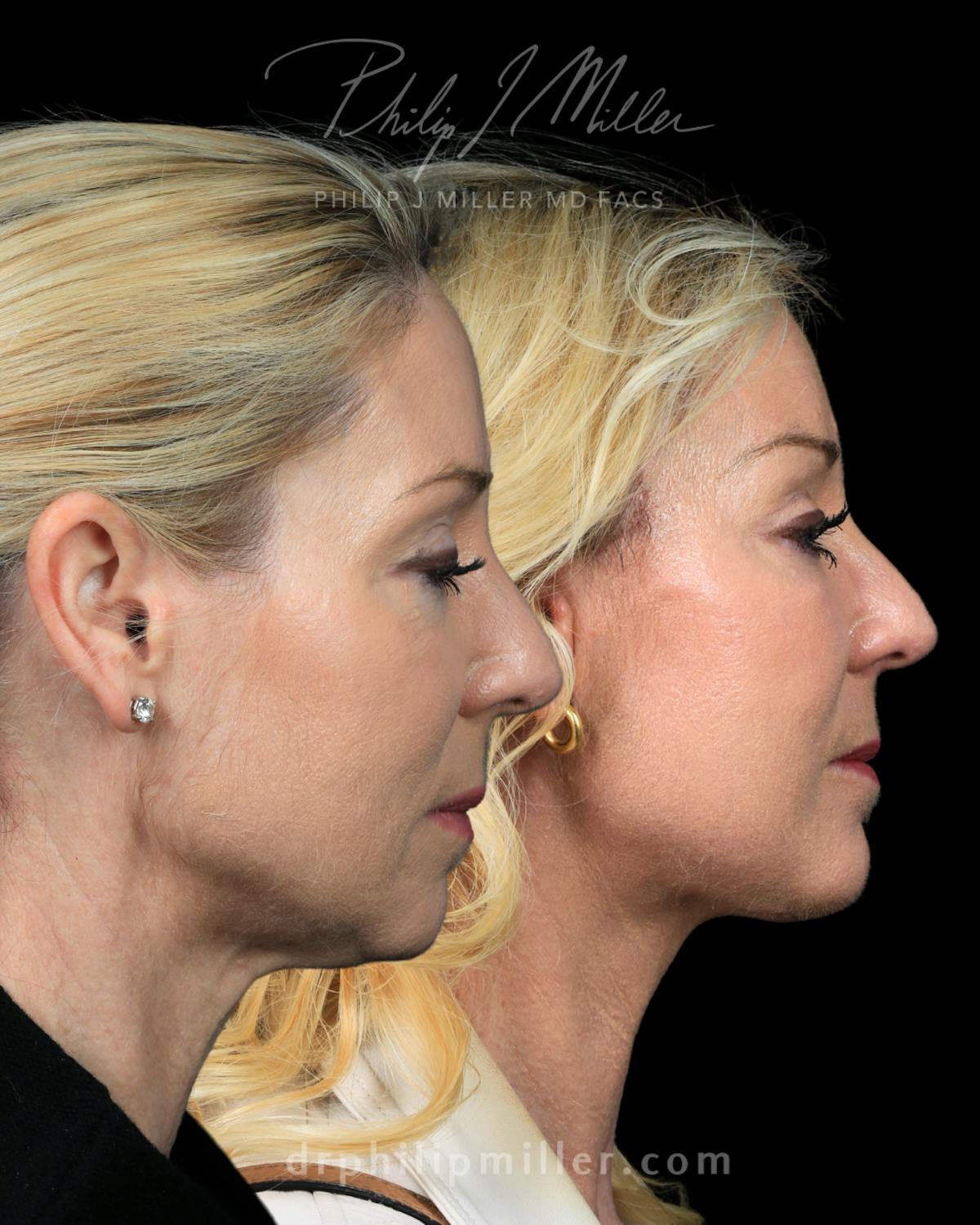 Micro Lift Before & After Gallery - Patient 235706 - Image 3