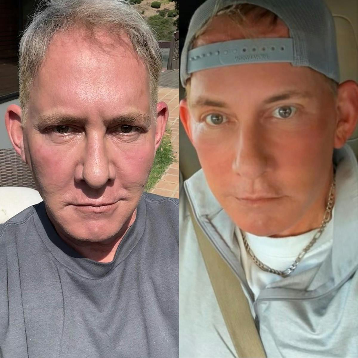 Facelift/NatraLift Before & After Gallery - Patient 364114 - Image 1