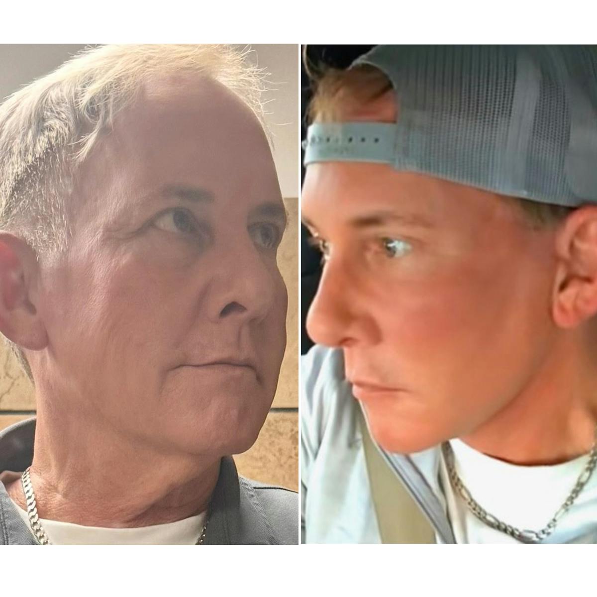 Facelift/NatraLift Before & After Gallery - Patient 364114 - Image 2