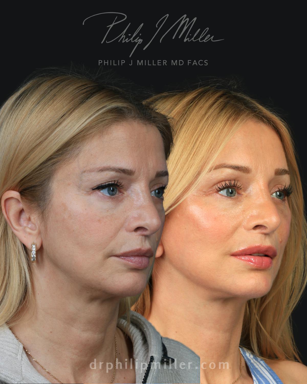 Facelift/NatraLift Before & After Gallery - Patient 147503 - Image 1