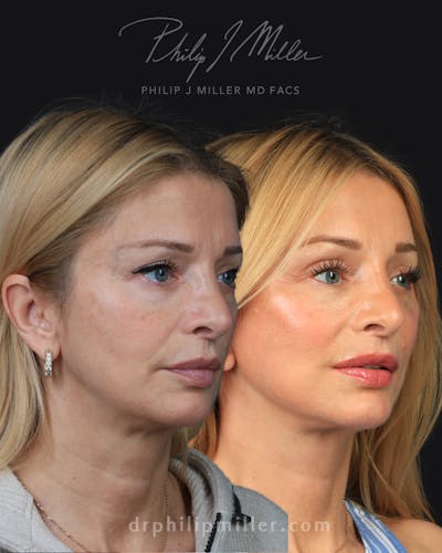 Facelift/NatraLift Before & After Gallery - Patient 147503 - Image 1