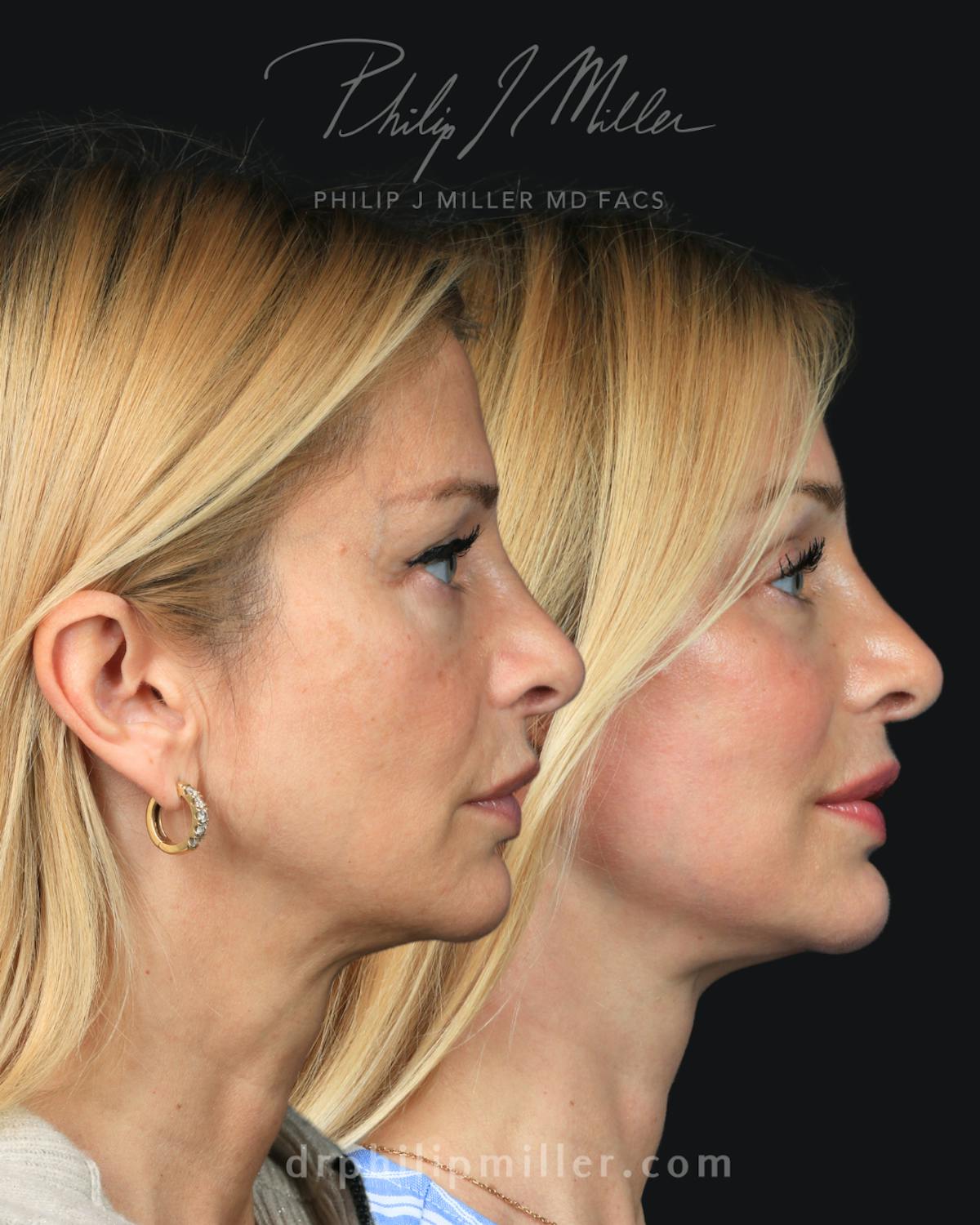 Facelift/NatraLift Before & After Gallery - Patient 147503 - Image 2