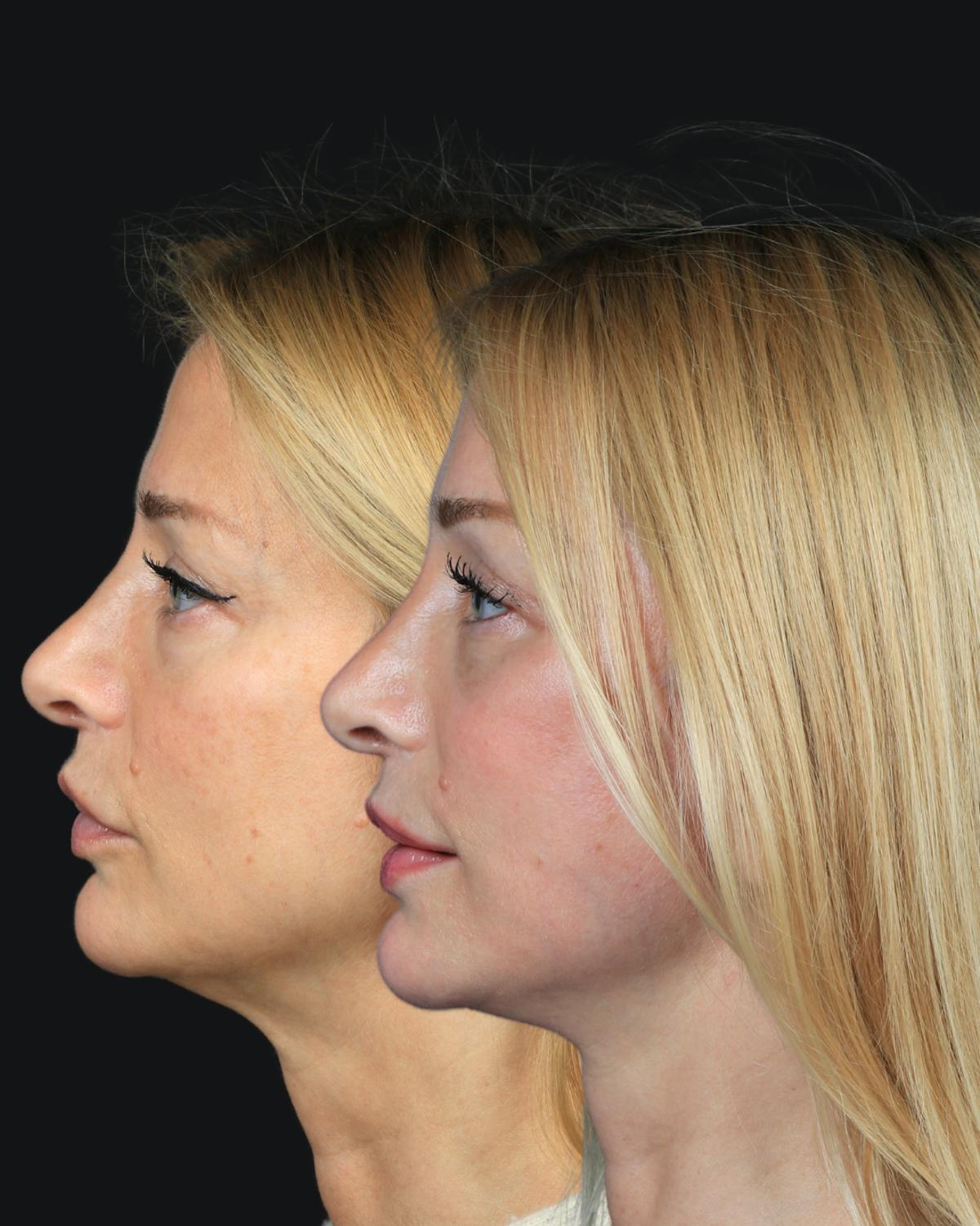 Facelift/NatraLift Before & After Gallery - Patient 147503 - Image 4