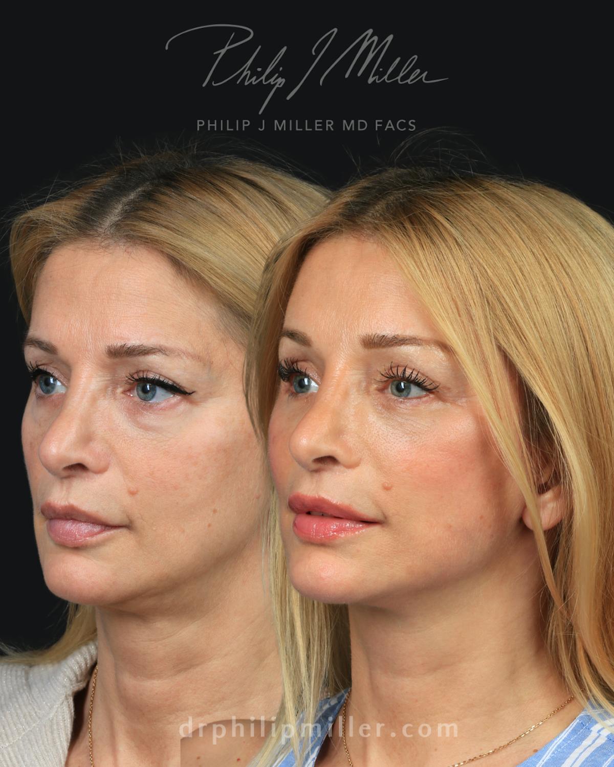 Facelift/NatraLift Before & After Gallery - Patient 147503 - Image 3