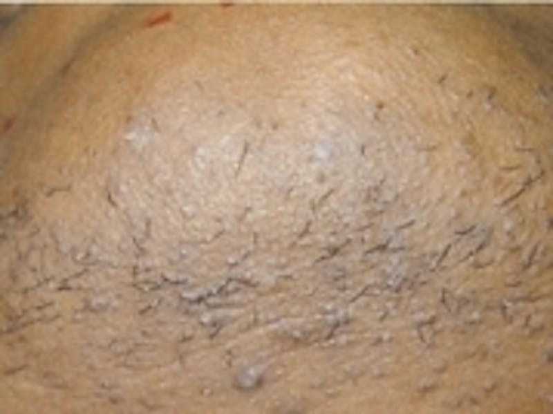 Laser Hair Removal Before & After Gallery - Patient 20490481 - Image 1