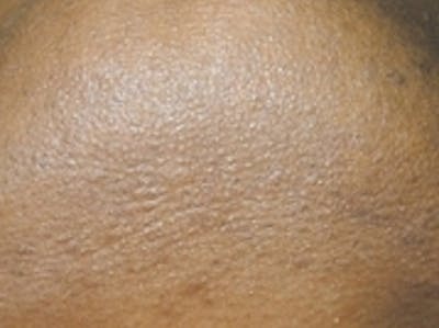 Laser Hair Removal Before & After Gallery - Patient 20490481 - Image 2