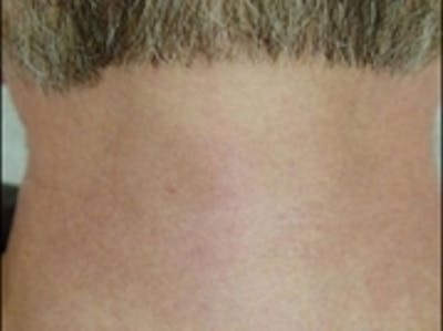Laser Hair Removal Before & After Gallery - Patient 20490482 - Image 2