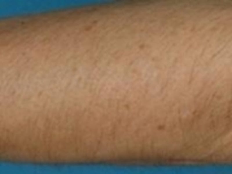 Laser Hair Removal Before & After Gallery - Patient 20490483 - Image 1