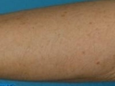 Laser Hair Removal Before & After Gallery - Patient 20490483 - Image 2