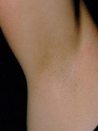 Laser Hair Removal Before & After Gallery - Patient 20490484 - Image 2