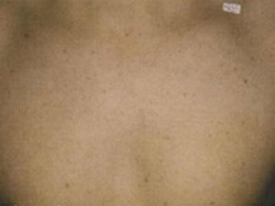 Laser Hair Removal Before & After Gallery - Patient 20491023 - Image 2