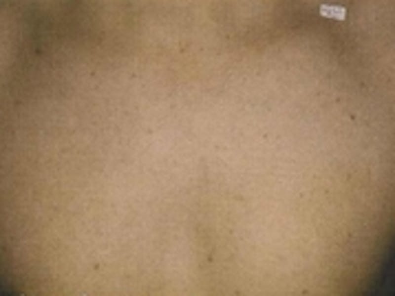Laser Hair Removal Before & After Gallery - Patient 20491023 - Image 2