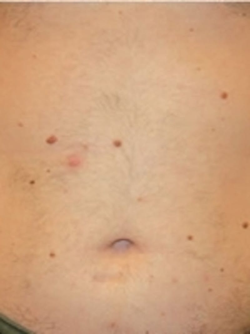 Laser Hair Removal Before & After Gallery - Patient 20491024 - Image 2