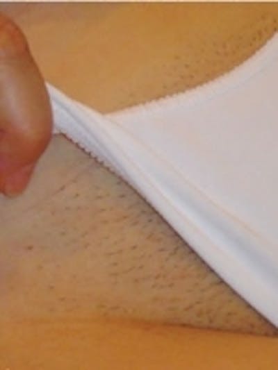 Laser Hair Removal Before & After Gallery - Patient 20491025 - Image 1