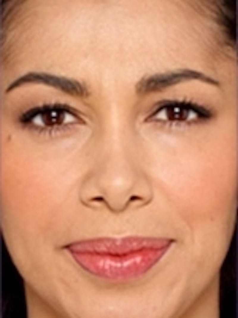 Botox Before & After Gallery - Patient 20492644 - Image 2