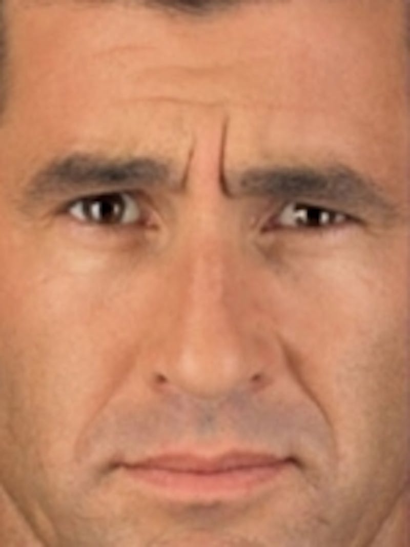 Botox Before & After Gallery - Patient 20492646 - Image 1
