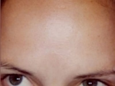 Botox Before & After Gallery - Patient 20492647 - Image 2