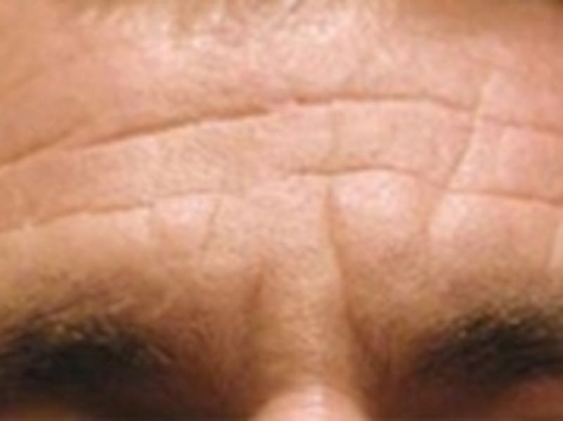 Botox Before & After Gallery - Patient 20492648 - Image 1