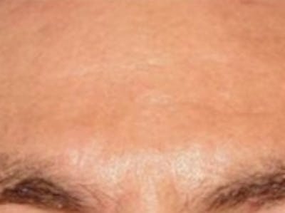 Botox Before & After Gallery - Patient 20492648 - Image 2