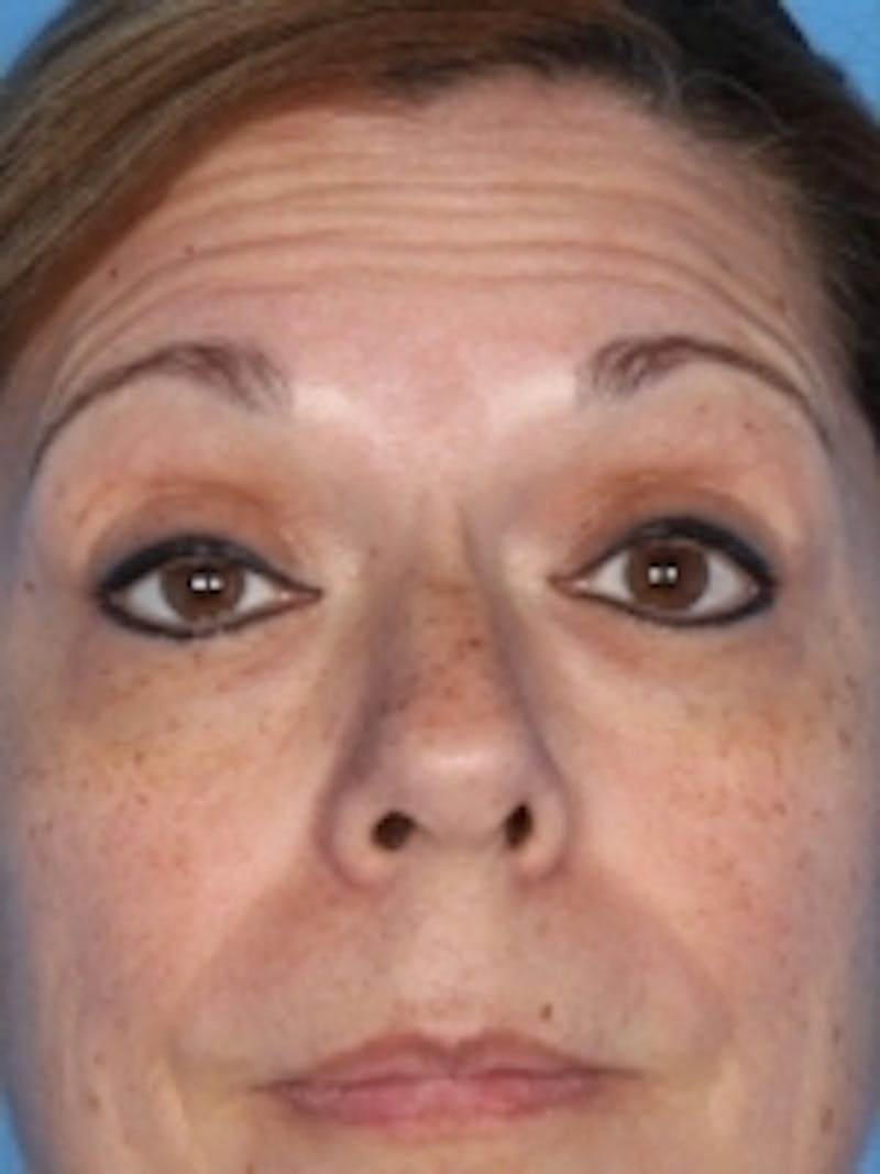 Botox Before & After Gallery - Patient 20492649 - Image 1