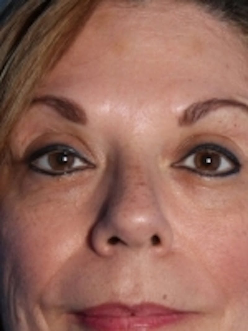 Botox Before & After Gallery - Patient 20492649 - Image 2