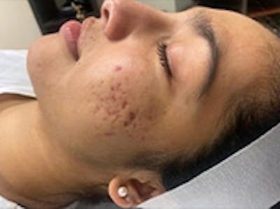 Facial Aesthetic Services Before & After Gallery - Patient 20493188 - Image 1
