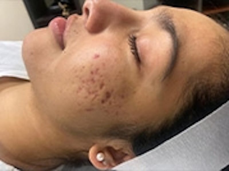 Facial Aesthetic Services Before & After Gallery - Patient 20493188 - Image 1