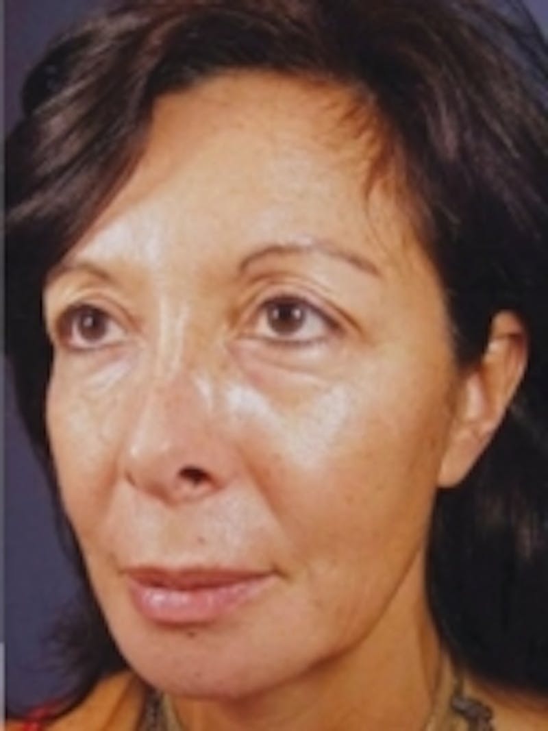 Facial Aesthetic Services Before & After Gallery - Patient 20493189 - Image 2