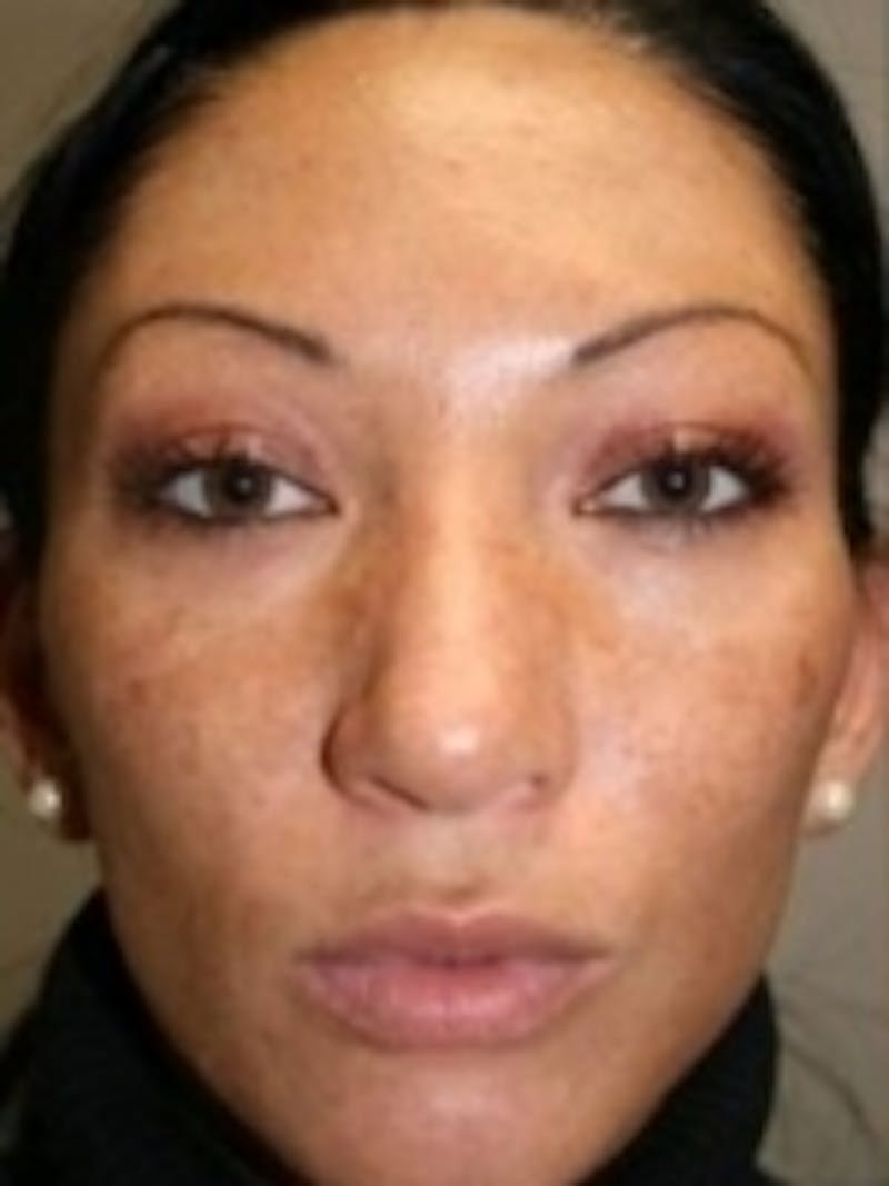 Facial Aesthetic Services Before & After Gallery - Patient 20493191 - Image 1