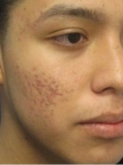 Scar Removal Before & After Gallery - Patient 20493192 - Image 1