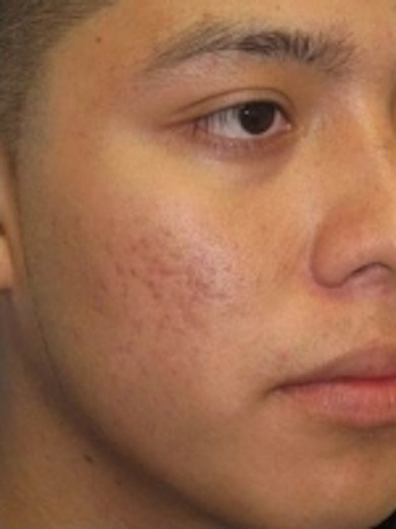 Scar Removal Before & After Gallery - Patient 20493192 - Image 2