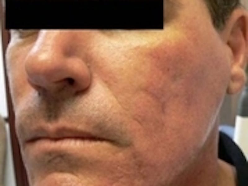 Scar Removal Before & After Gallery - Patient 20493194 - Image 2