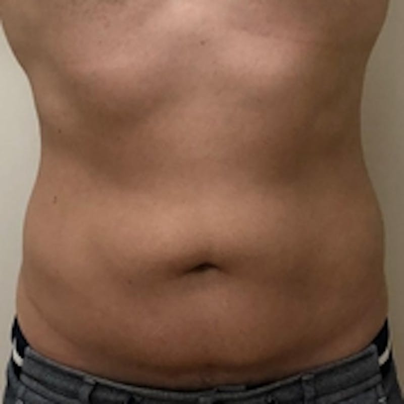 Body Sculpting Before & After Gallery - Patient 20493195 - Image 2