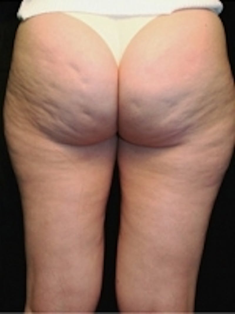 Body Sculpting Before & After Gallery - Patient 20493197 - Image 1