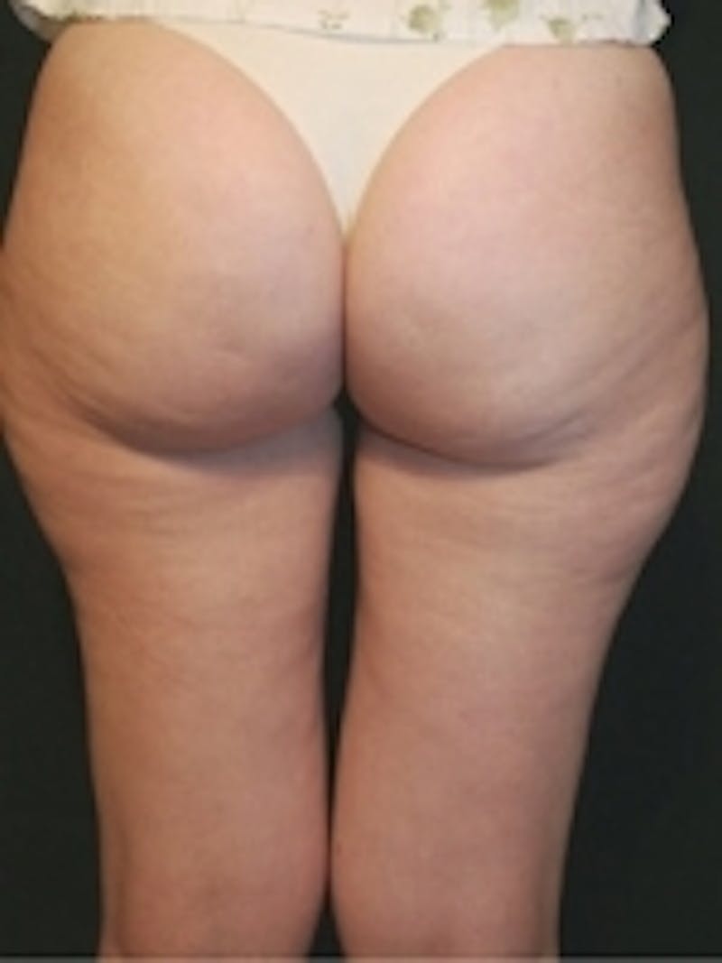 Body Sculpting Before & After Gallery - Patient 20493197 - Image 2